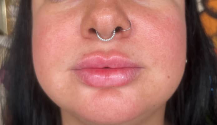 Dermal Fillers / Lips