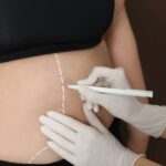 How Many Sessions For Liquid Liposuction?