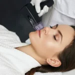 Microneedling with RF